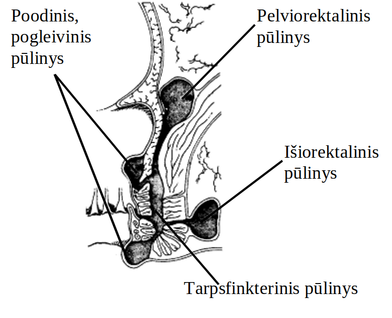 8 paveikslėlis. Galimos pūlinių lokalizacijos.